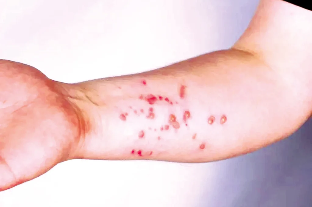 Secretaria de Saúde de Mossoró Descartou Caso de Monkeypox em Paciente Potiguar Secretaria de Saúde de Mossoró Descartou Caso de Monkeypox em Paciente Potiguar